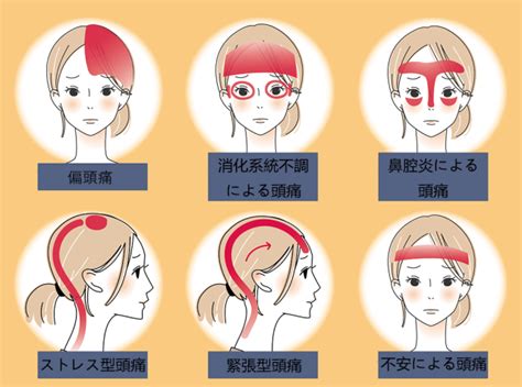 頭痛 位置|頭痛の原因｜種類によって痛む場所は違う？対処法や 